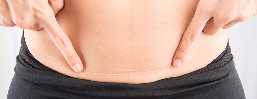 Jak pielęgnować bliznę po cesarce