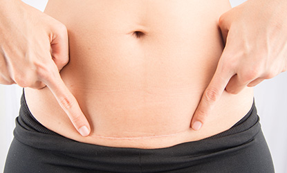 Jak pielęgnować bliznę po cesarce